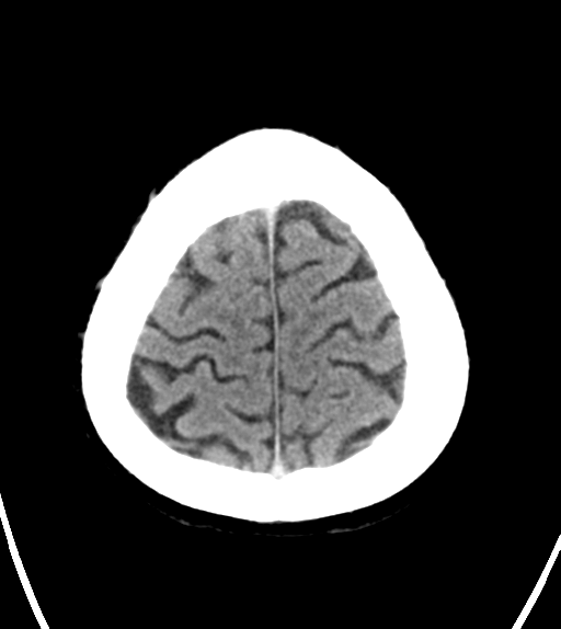 File:Aqueduct stenosis with corpus callosum hypoattenuation post shunting (Radiopaedia 37212-38971 Axial non-contrast 26).png