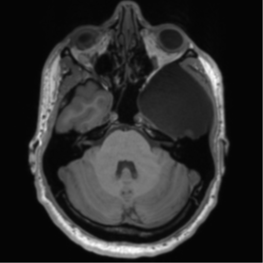 File:Arachnoid cyst with subdural hematoma (Radiopaedia 85892-101743 Axial T1 27).png