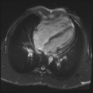 File:Arrhythmogenic right ventricular cardiomyopathy (Radiopaedia 57972-64966 A 18).jpg