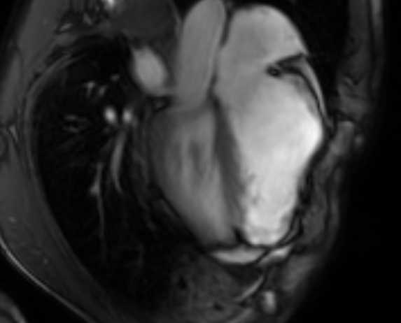 File:Arrhythmogenic right ventricular cardiomyopathy (Radiopaedia 69564-79464 4ch cine 88).jpg