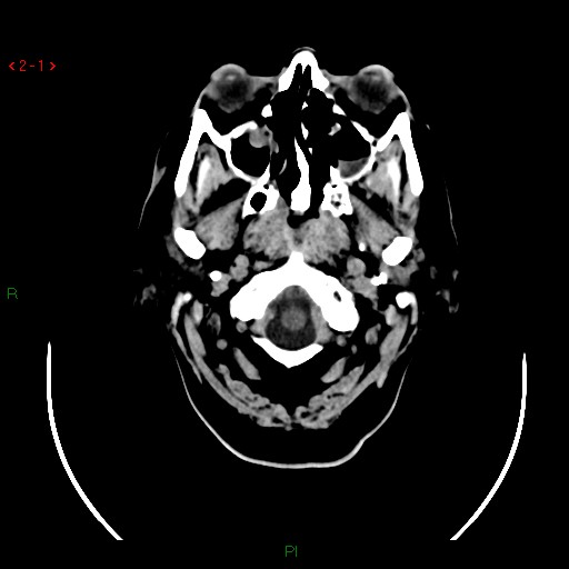 File:Arterio-venous malformation in the brain (Radiopaedia 14785).jpg