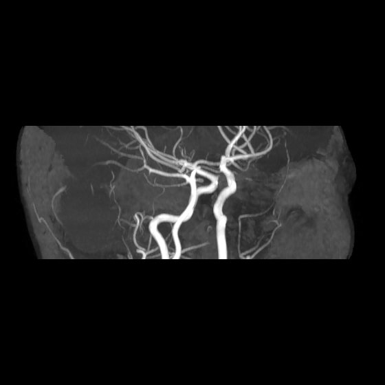File:Artery of Percheron infarct (Radiopaedia 40966-43676 G 13).jpg