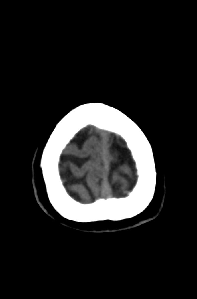 Artery of Percheron infarction (Radiopaedia 80613-94202 Axial non-contrast 178).jpg