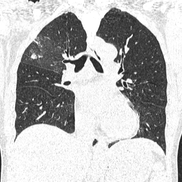 File:Aspergilloma (Radiopaedia 26223-26347 Coronal lung window 28).jpg