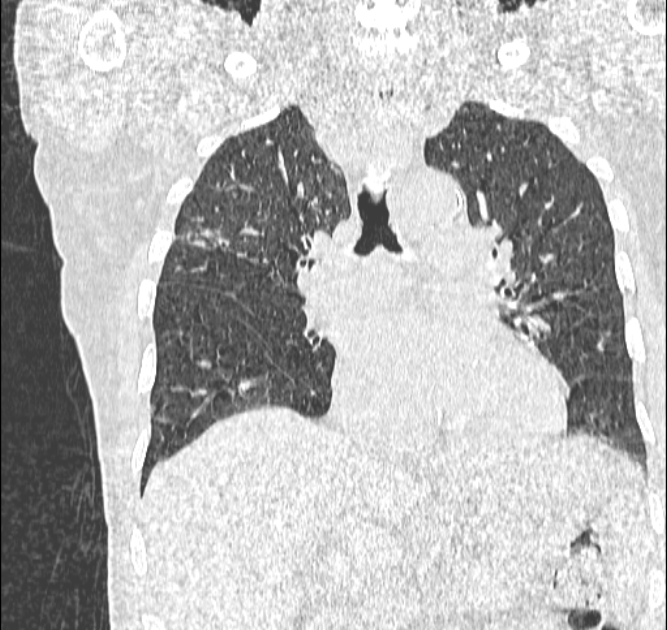 Aspergilloma (Radiopaedia 44592-48327 Coronal lung window 62).jpg