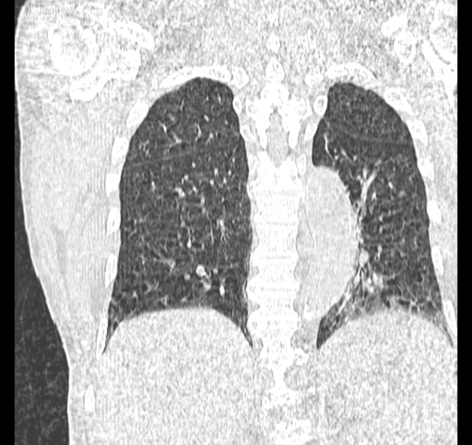 Aspergilloma (Radiopaedia 44592-48327 Coronal lung window 95).jpg