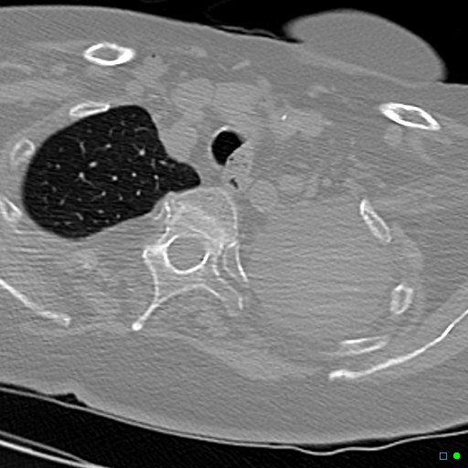 File:Aspirated food bolus obstruction of left main bronchus (Radiopaedia 29432-29904 Axial non-contrast 2).jpg