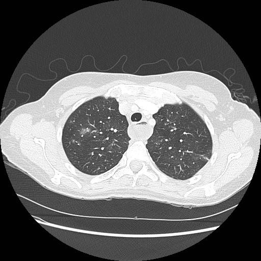 Aspiration pneumonia secondary to laparoscopic banding (Radiopaedia 18345-18183 lung window 22).jpg