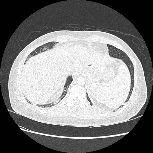 Aspiration pneumonia secondary to laparoscopic banding (Radiopaedia 18345-18183 lung window 96).jpg