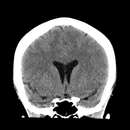 File:Atretic encephalocoele with inferior vermis hypoplasia (Radiopaedia 30443-31107 Coronal non-contrast 16).jpg