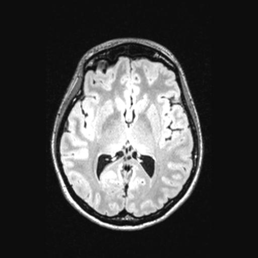 Atretic encephalocoele with inferior vermis hypoplasia (Radiopaedia 30443-31108 Axial 83).jpg