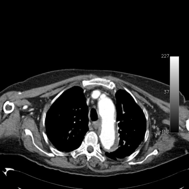 Atypical dissection of the thoracic aorta (Radiopaedia 10975-11393 A 16).jpg