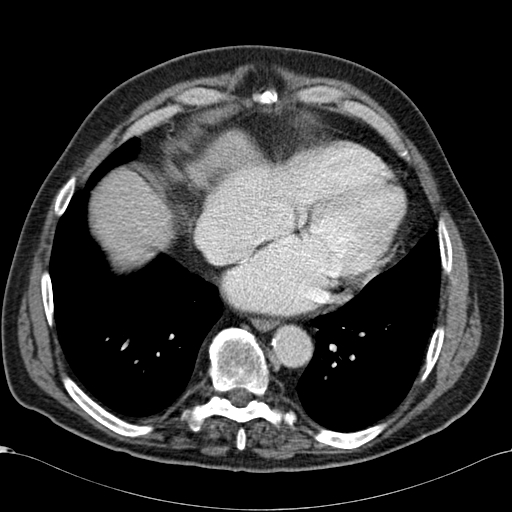 Atypical hepatocellular carcinoma (Radiopaedia 41744-44698 B 5).jpg