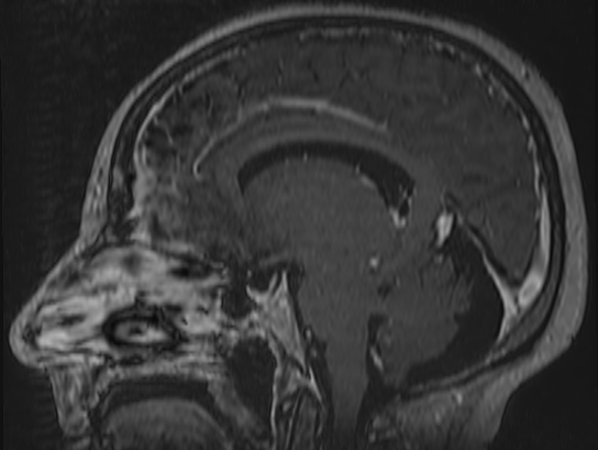 Atypical meningioma (Radiopaedia 62985-71406 Sagittal T1 C+ 46).jpg