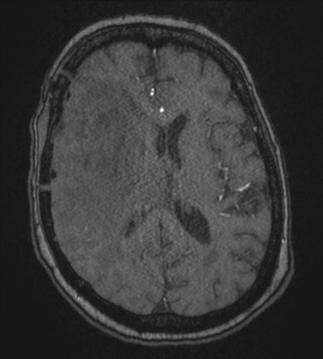 Atypical meningioma (WHO Grade II) (Radiopaedia 54742-60981 Axial MRA 57).png