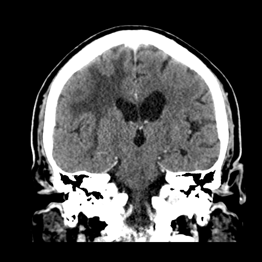 Atypical meningioma (WHO grade II) with brain invasion (Radiopaedia 57767-64728 Coronal C+ 35).png