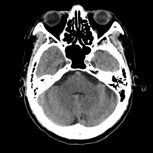 File:Atypical meningioma (WHO grade II) with osseous invasion (Radiopaedia 53654-59715 Axial non-contrast 16).png