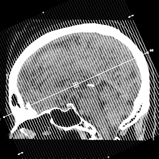 Atypical meningioma with skull invasion (Radiopaedia 34357-35649 Coronal non-contrast 1).png