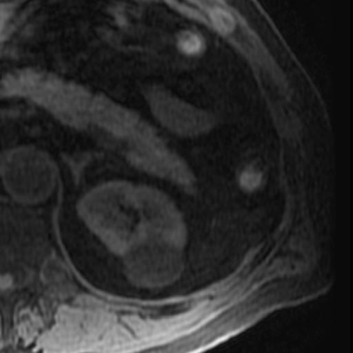 File:Atypical renal cyst on MRI (Radiopaedia 17349-17046 Axial T1 fat sat 8).jpg