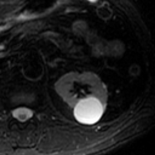 File:Atypical renal cyst on MRI (Radiopaedia 17349-17046 Axial T2 fat sat 8).jpg