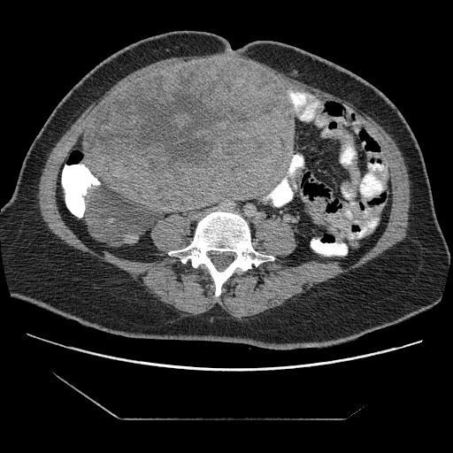File:Atypical retroperitoneal lymphocoeles with large leiomyoma of uterus (Radiopaedia 32084-33024 A 24).jpg