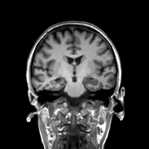 Autoimmune limbic encephalitis (Radiopaedia 30363-31005 Coronal T1 30).jpg