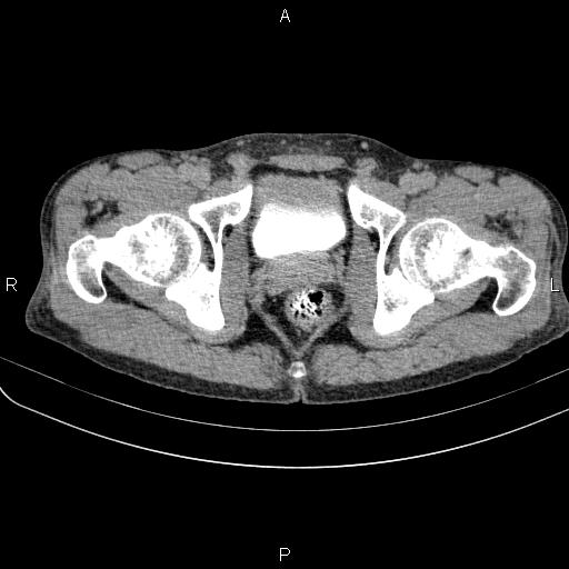 Autoimmune pancreatitis (Radiopaedia 84925-100431 Axial C+ delayed 96).jpg