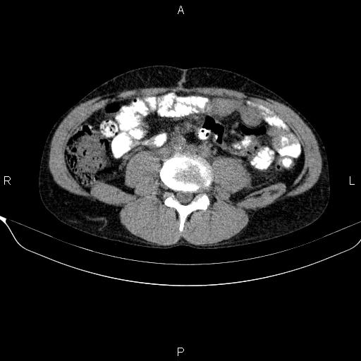 Autoimmune pancreatitis (Radiopaedia 84925-100431 Axial non-contrast 34).jpg