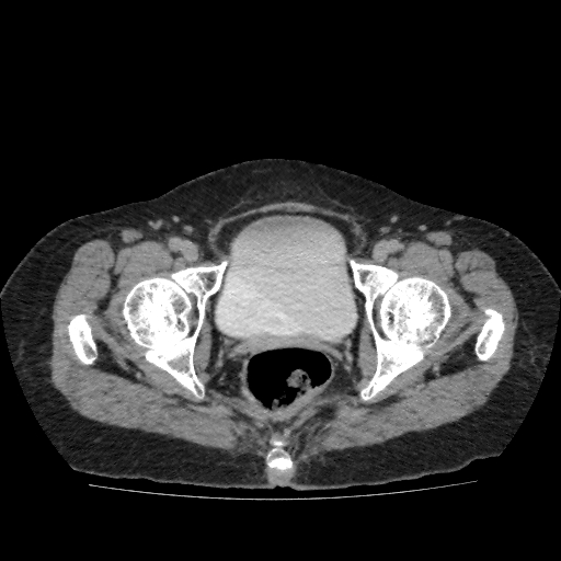 Autosomal dominant polycystic kidney disease (Radiopaedia 38189-40194 Axial C+ delayed 57).jpg