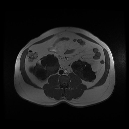 Autosomal dominant polycystic kidney disease (Radiopaedia 50259-55611 Axial 2D Dual Echo 60).jpg