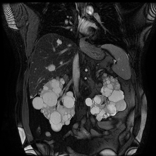 File:Autosomal dominant polycystic kidney disease (Radiopaedia 50259-55611 Coronal FIESTA 18).jpg
