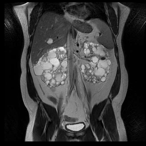 File:Autosomal dominant polycystic kidney disease (Radiopaedia 50259-55611 Coronal T2 20).jpg