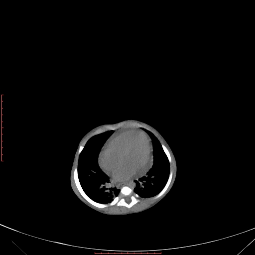 File:Autosomal recessive polycystic kidney disease associated with Caroli disease (Radiopaedia 61932-69984 Axial non-contrast 81).jpg