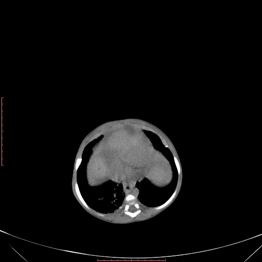 Autosomal recessive polycystic kidney disease associated with Caroli disease (Radiopaedia 61932-69984 B 97).jpg