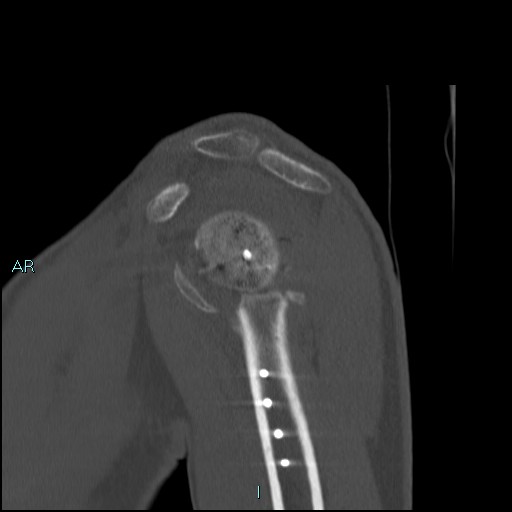 Avascular necrosis after fracture dislocations of the proximal humerus (Radiopaedia 88078-104653 Sagittal bone window 29).jpg