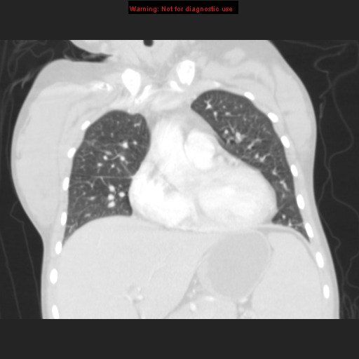 File:Avascular necrosis in sickle cell disease (Radiopaedia 17448-17152 B 44).jpg