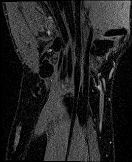 Avascular necrosis of the capitate (Radiopaedia 88317-104948 Coronal T1 vibe 65).jpg