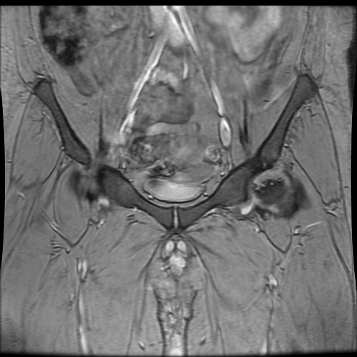Avascular necrosis of the hip (Radiopaedia 61503-69465 F 24).jpg