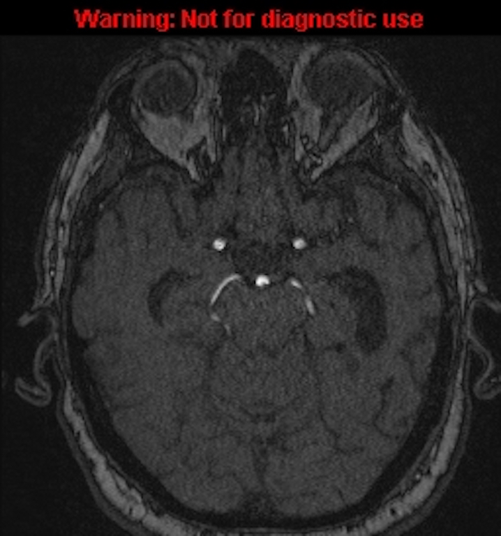 Azygos anterior cerebral artery (Radiopaedia 59325-66677 Axial MRA 62).jpg