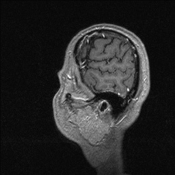 Balo concentric sclerosis (Radiopaedia 50458-55940 Sagittal T1 C+ 23).jpg