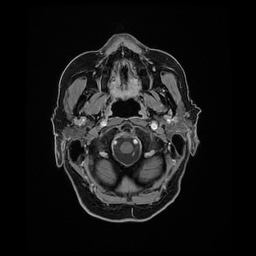 Balo concentric sclerosis (Radiopaedia 53875-59982 Axial LAVA C+ 25).jpg