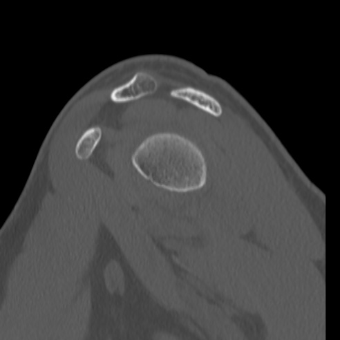 Bankart lesion (Radiopaedia 57256-64185 Sagittal bone window 25).jpg