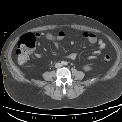 File:Bariatric balloon causing gastric outlet obstruction (Radiopaedia 54449-60672 A 25).jpg