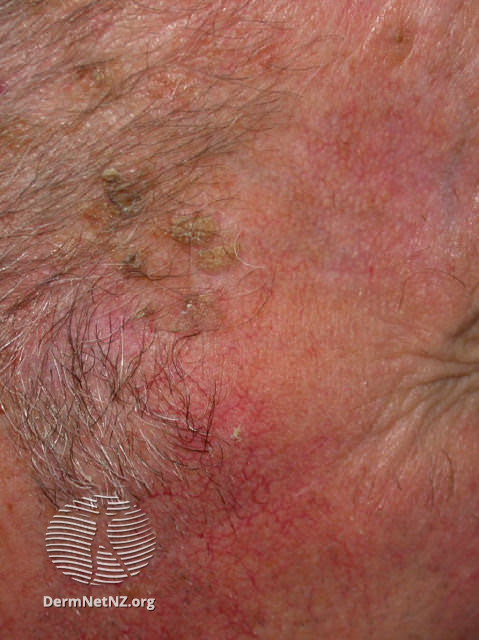 Basal cell carcinoma affecting the face (DermNet NZ lesions-bcc-face-0892).jpg