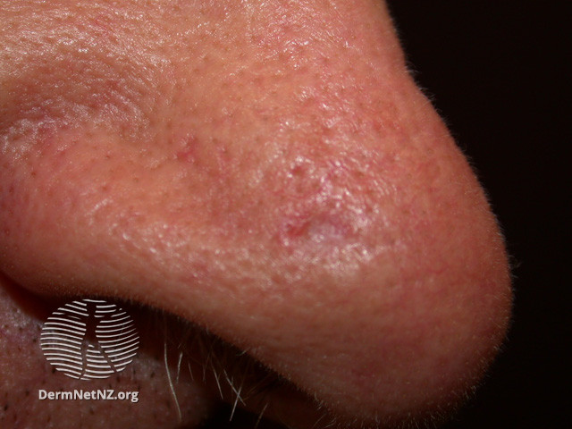 File:Basal cell carcinoma affecting the nose (DermNet NZ lesions-bcc-nose-0903).jpg