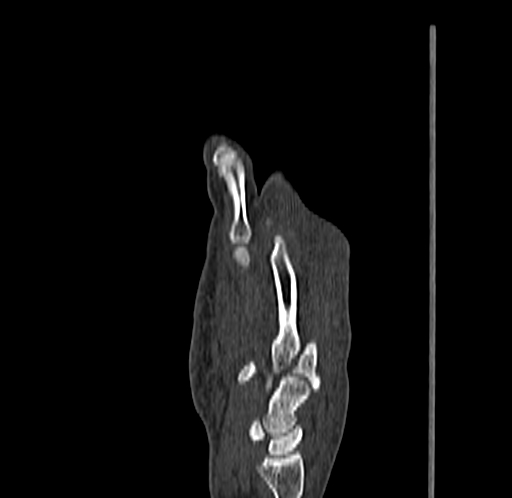 Base of 2nd metacarpal fracture (Radiopaedia 73741-84544 Sagittal bone window 42).jpg