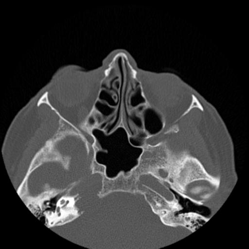 File:Base of skull chondrosarcoma (Radiopaedia 30410-31071 Axial bone window 22).jpg