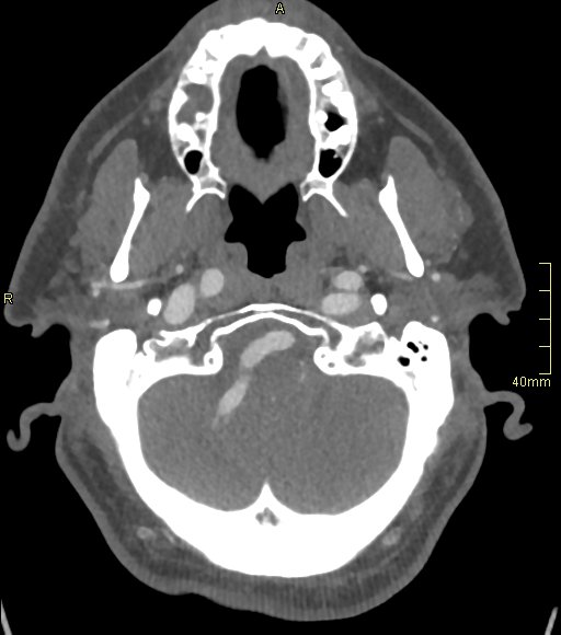 Basilar artery aneurysm (Radiopaedia 56261-62932 A 40).jpg