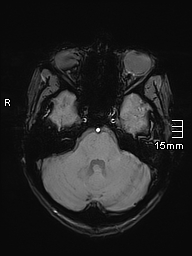 Basilar artery perforator aneurysm (Radiopaedia 82455-99523 Axial SWI 17).jpg