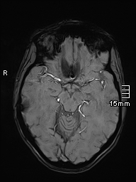 Basilar artery perforator aneurysm (Radiopaedia 82455-99523 Axial SWI 26).jpg
